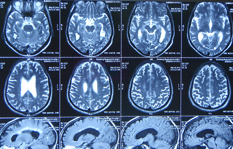 менингиома головного мозга лечение без операции