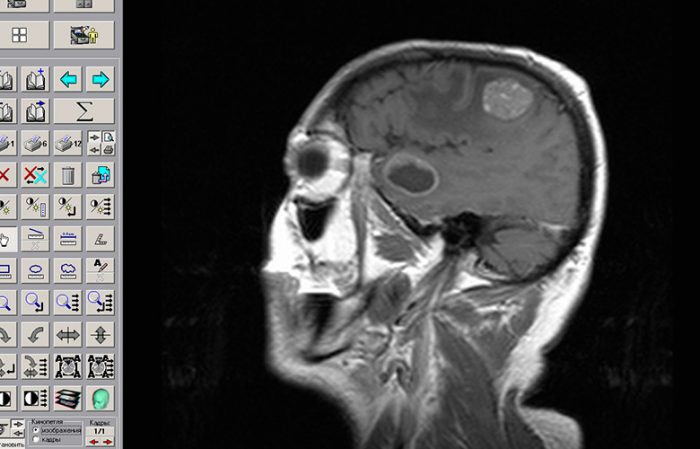 Benign brain tumor how long do you live with it?