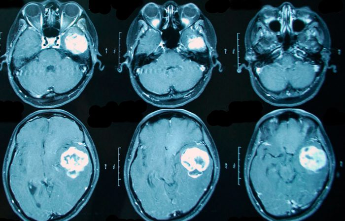 How does brain cancer manifest?