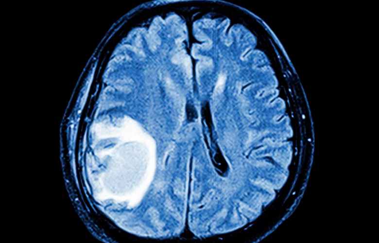 piloid astrocytoma of the brain