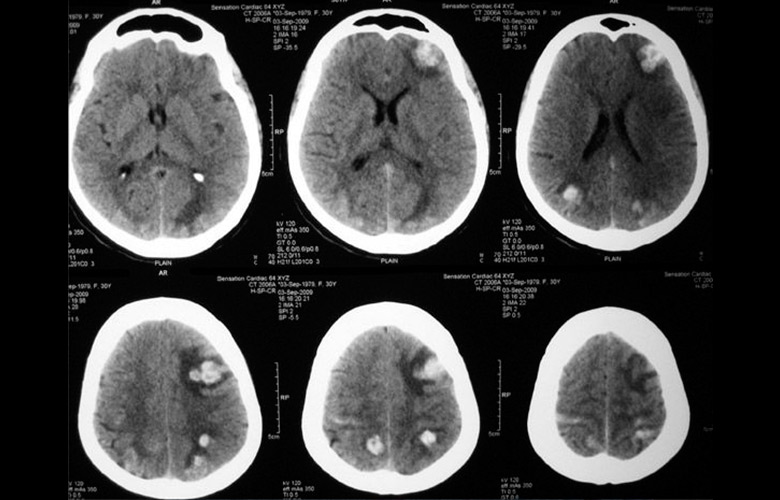 metastases in brain cancer