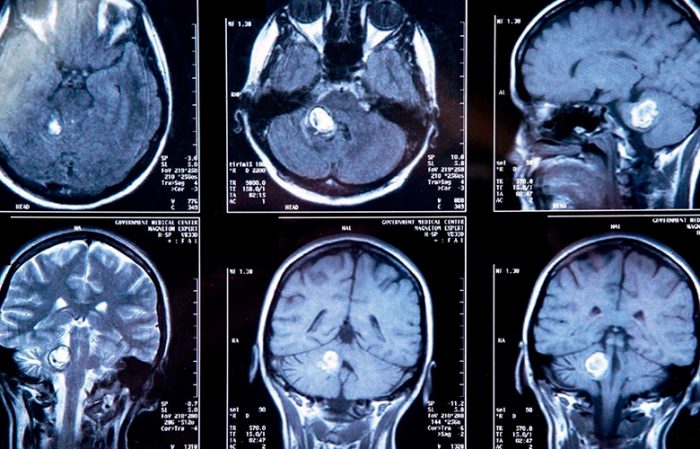 Signs of a benign brain tumor