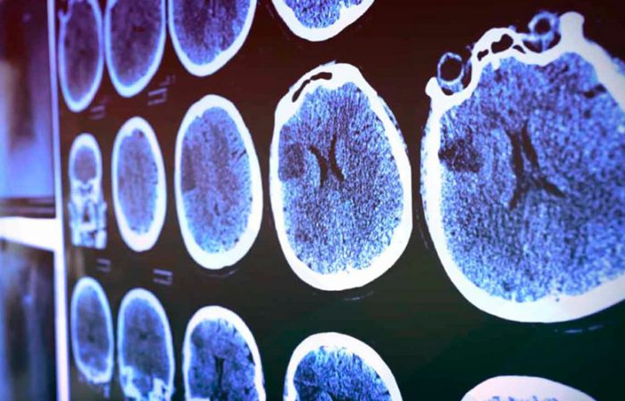 Signs of a brain tumor symptoms