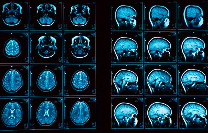 Microadenoma of the pituitary gland of the brain