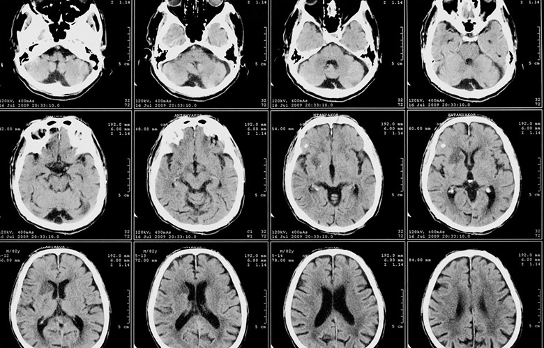 Tumor of the temporal lobe of the brain