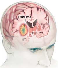 Рак ствола головного мозга. Глиома ствола головного мозга симптомы. Диффузная глиома ствола головного мозга.